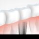 soluciones en implantes dentales