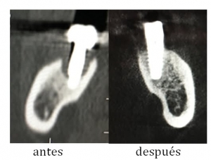Antes y después de la regeneración del hueso dental