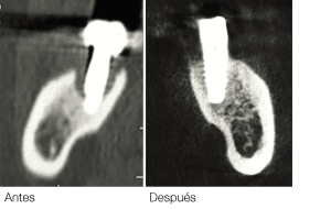 Antes y Después Peri-implantitis