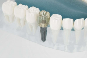 Implante dental tras peri-implantitis