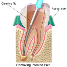 Endodoncia para diente roto o dañado por traumatismos dentales