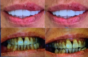 Antes y después de las carillas dentales en clínica dental Aviñó en Valencia