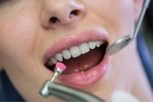 Hay que realizarse una limpieza dental más exhaustiva debido a los riesgos que existen de llevar pirecing en la lengua.